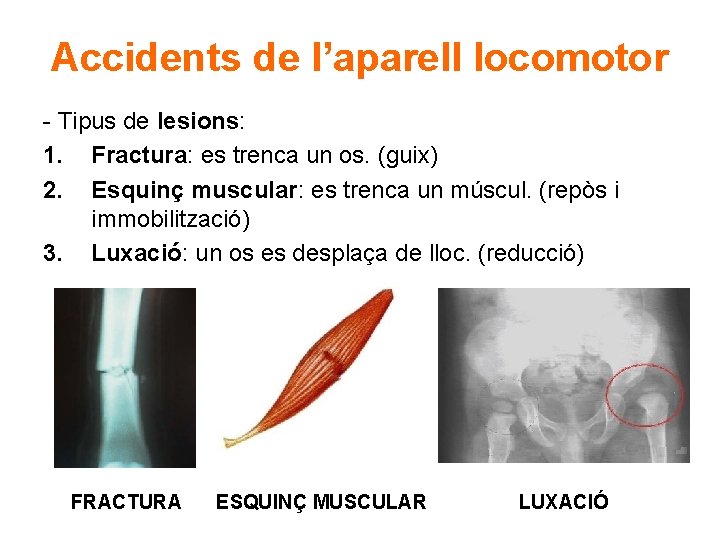 Accidents de l’aparell locomotor - Tipus de lesions: 1. Fractura: es trenca un os.