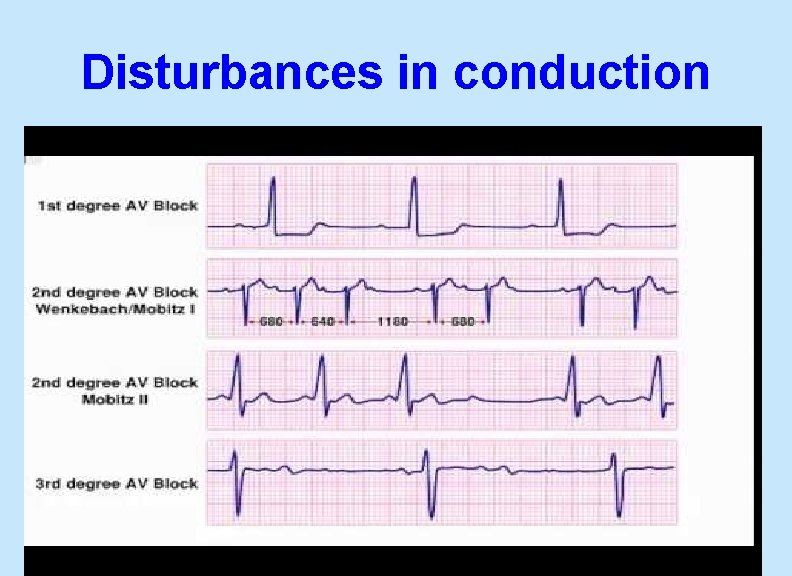 Disturbances in conduction 20 