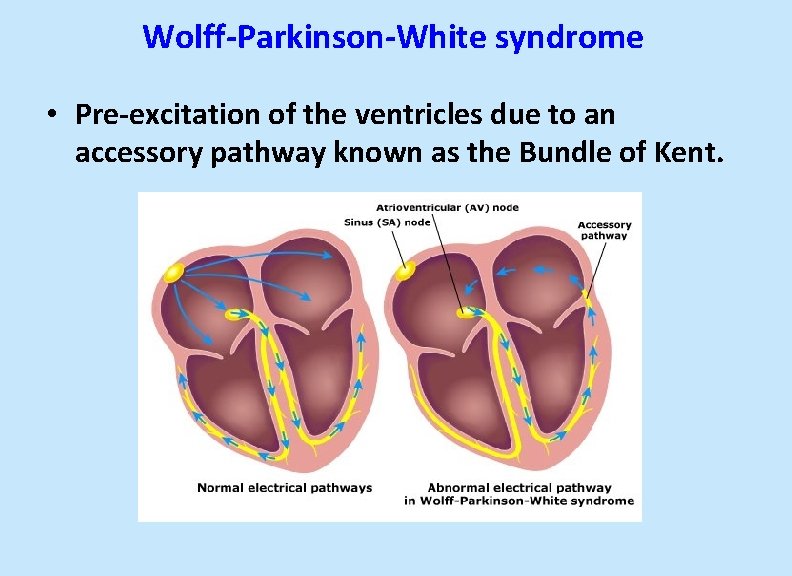 Wolff-Parkinson-White syndrome • Pre-excitation of the ventricles due to an accessory pathway known as