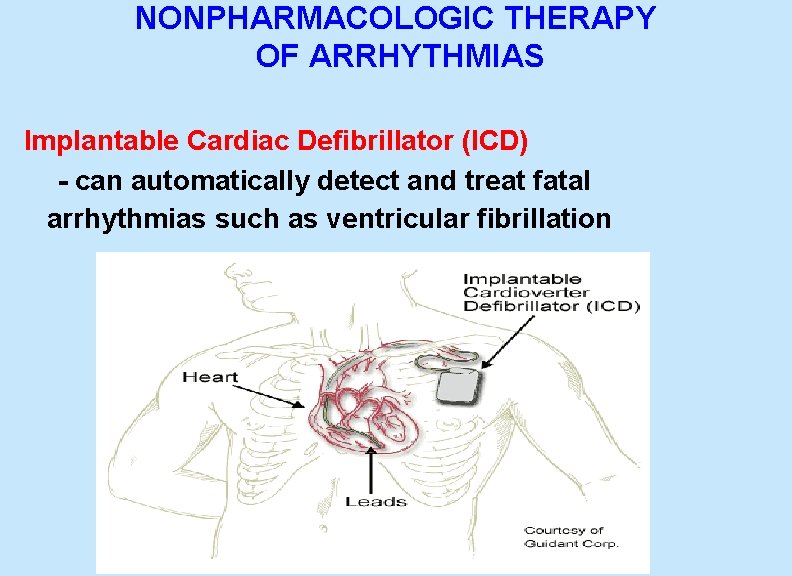 NONPHARMACOLOGIC THERAPY OF ARRHYTHMIAS Implantable Cardiac Defibrillator (ICD) - can automatically detect and treat