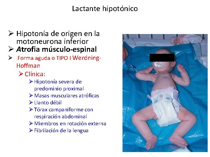 Lactante hipotónico Ø Hipotonía de origen en la motoneurona inferior Ø Atrofia músculo-espinal Ø