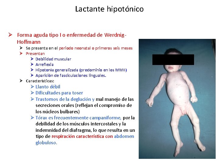 Lactante hipotónico Ø Forma aguda tipo I o enfermedad de Werdnig. Hoffmann Ø Se