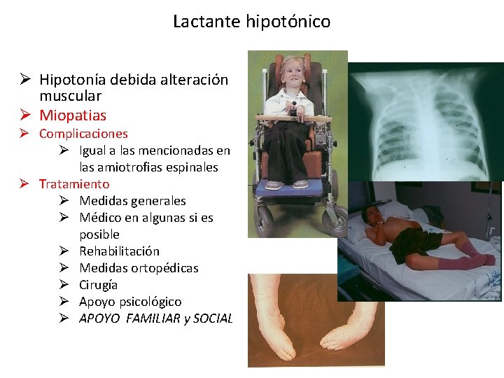 Lactante hipotónico Ø Hipotonía debida alteración muscular Ø Miopatias Ø Complicaciones Ø Igual a