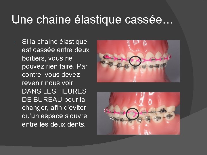 Une chaine élastique cassée… Si la chaine élastique est cassée entre deux boîtiers, vous