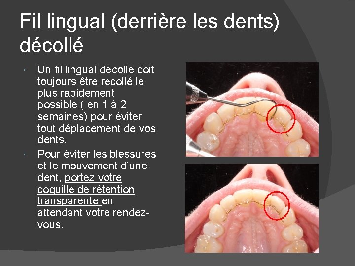 Fil lingual (derrière les dents) décollé Un fil lingual décollé doit toujours être recollé