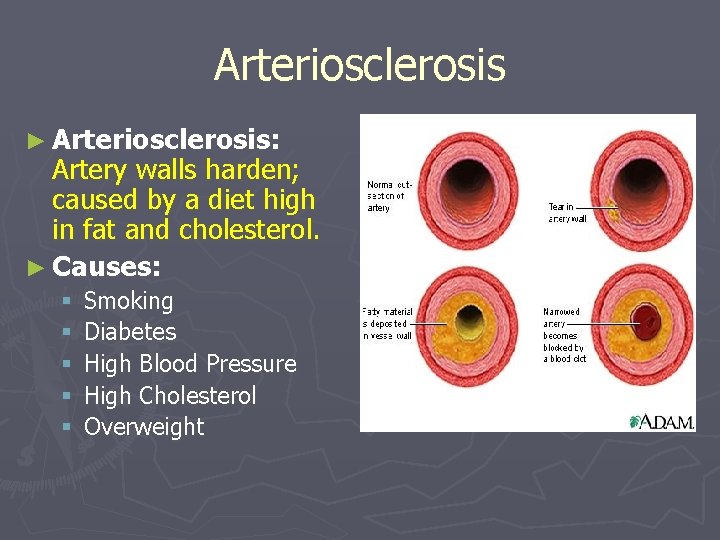 Arteriosclerosis ► Arteriosclerosis: Artery walls harden; caused by a diet high in fat and