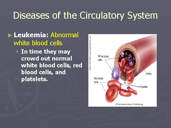 Diseases of the Circulatory System ► Leukemia: Abnormal white blood cells § In time
