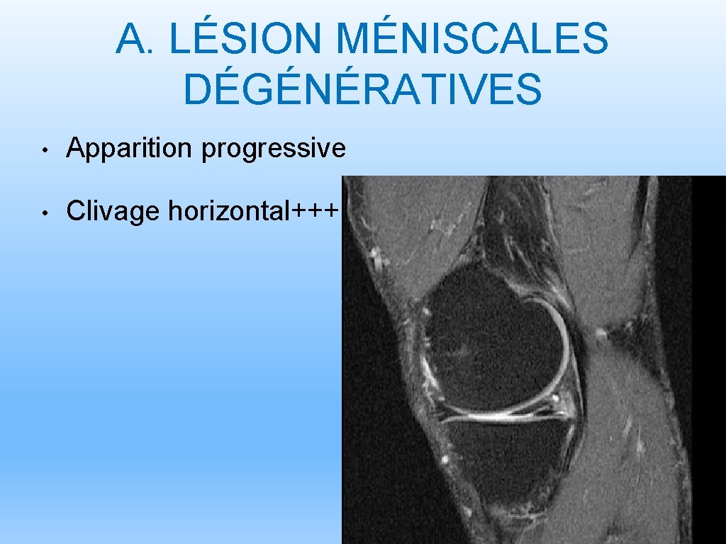 A. LÉSION MÉNISCALES DÉGÉNÉRATIVES • Apparition progressive • Clivage horizontal+++ 