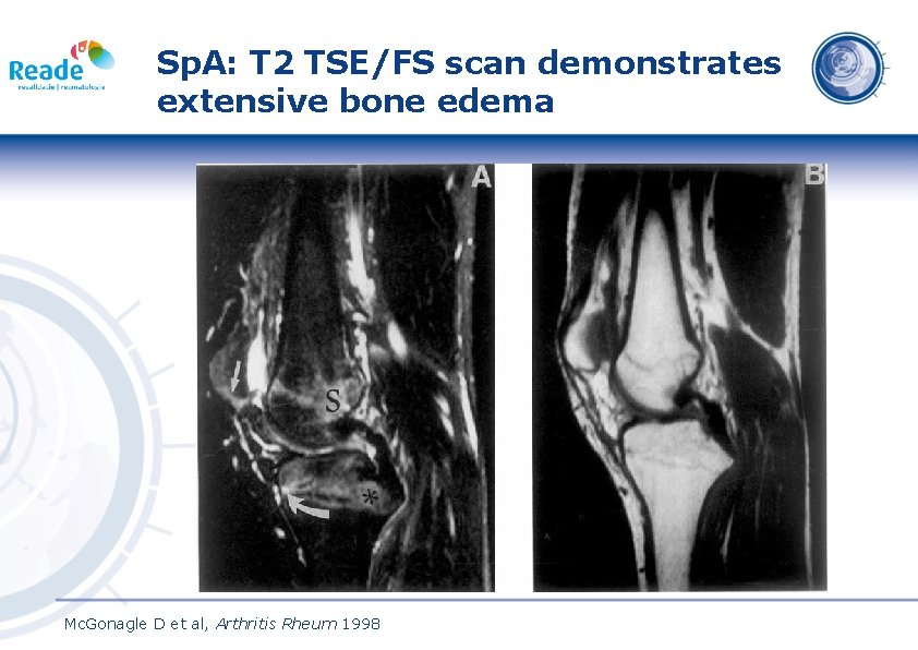 Sp. A: T 2 TSE/FS scan demonstrates extensive bone edema Mc. Gonagle D et
