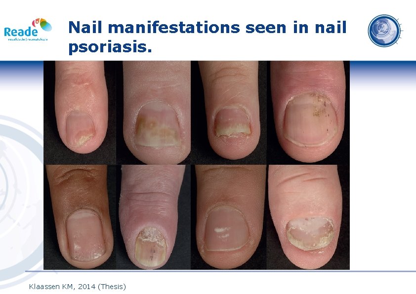 Nail manifestations seen in nail psoriasis. Klaassen KM, 2014 (Thesis) 