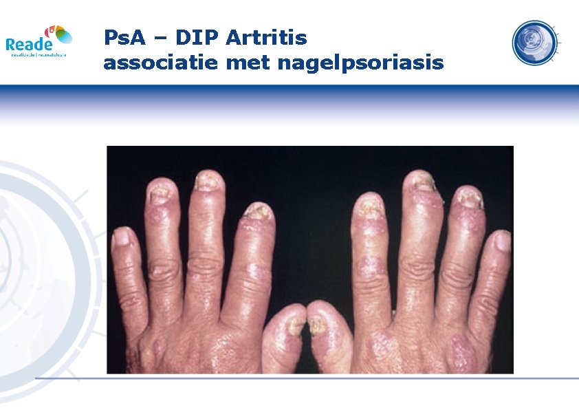 Ps. A – DIP Artritis associatie met nagelpsoriasis 