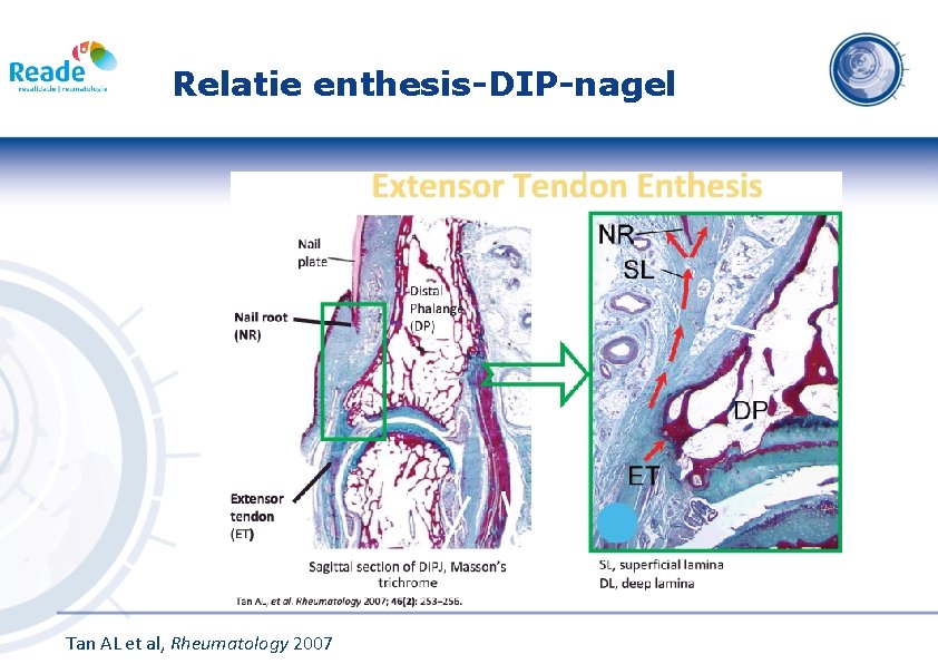 Relatie enthesis-DIP-nagel Tan AL et al, Rheumatology 2007 
