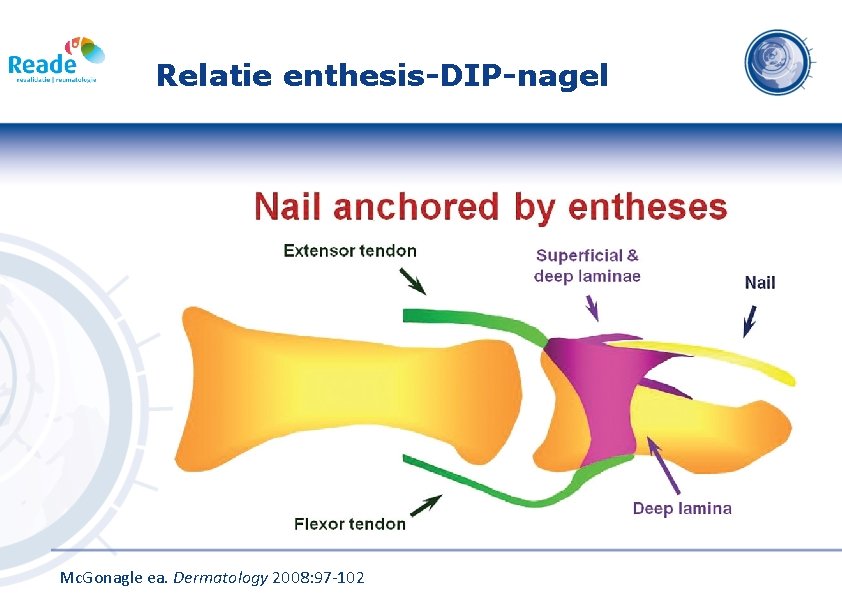 Relatie enthesis-DIP-nagel Mc. Gonagle ea. Dermatology 2008: 97 -102 