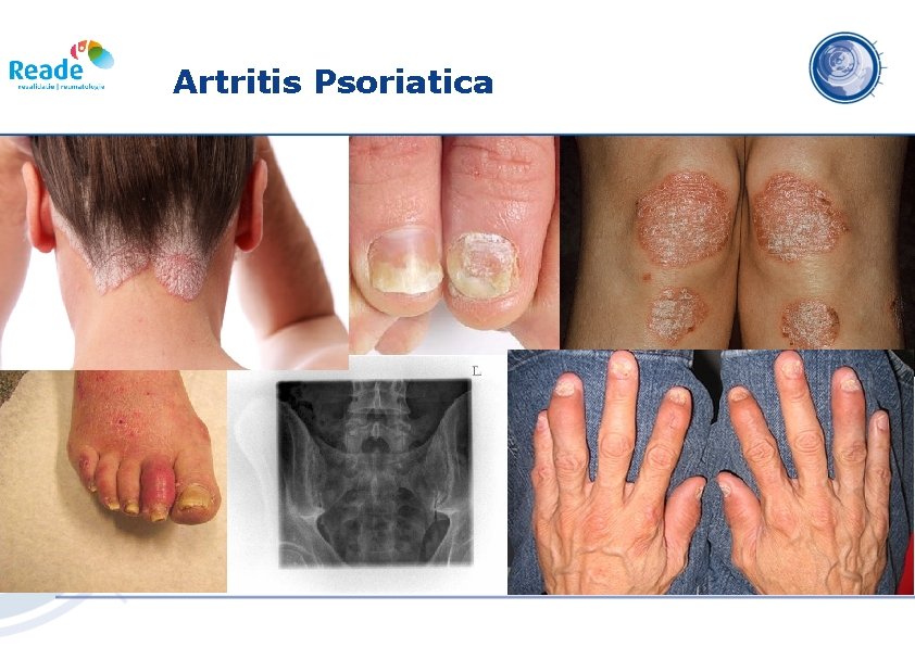 artritis psoriatica limfom al durerii articulare