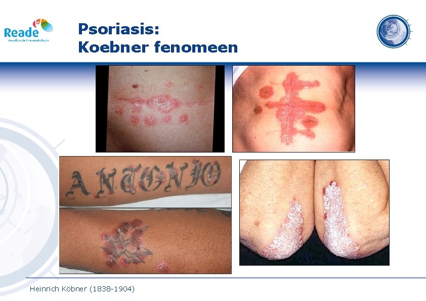 Psoriasis: Koebner fenomeen Heinrich Köbner (1838 -1904) 