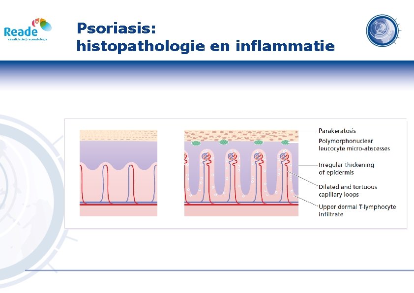 Psoriasis: histopathologie en inflammatie 