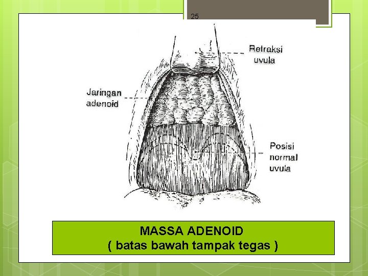 25 MASSA ADENOID ( batas bawah tampak tegas ) 25 MASSA ADENOID ( batas bawah tampak tegas )