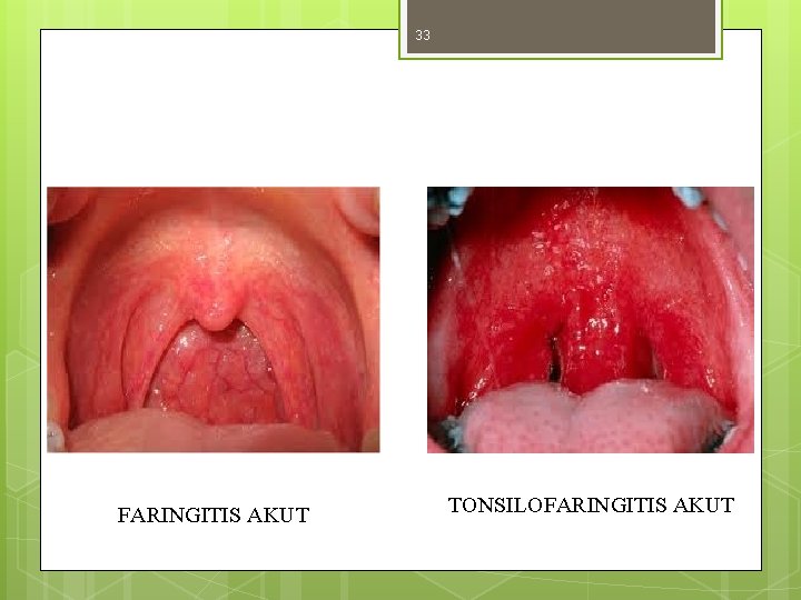 33 FARINGITIS AKUT TONSILOFARINGITIS AKUT 33 FARINGITIS AKUT TONSILOFARINGITIS AKUT