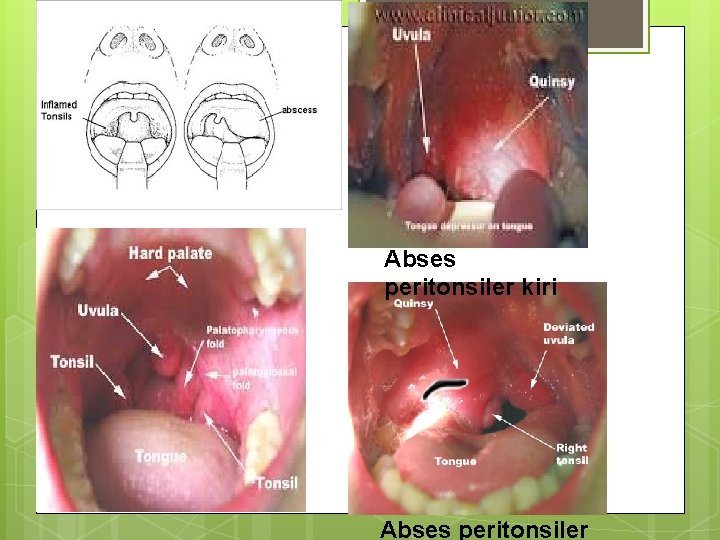 Abses peritonsiler kiri Abses peritonsiler Abses peritonsiler kiri Abses peritonsiler