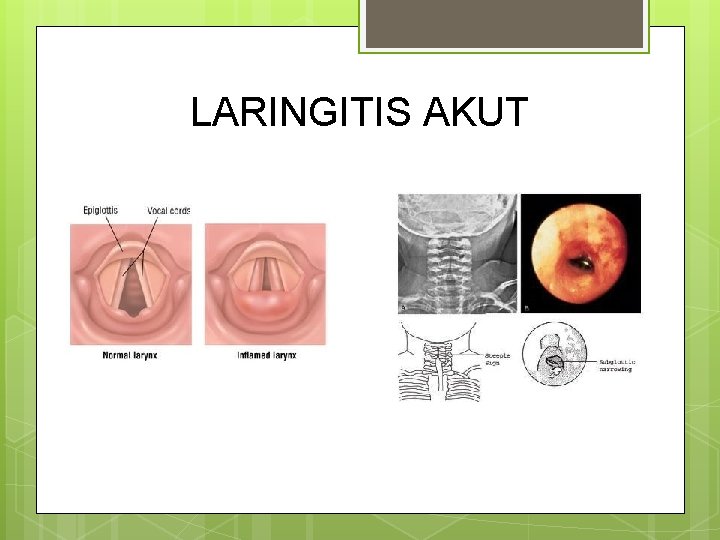 LARINGITIS AKUT LARINGITIS AKUT