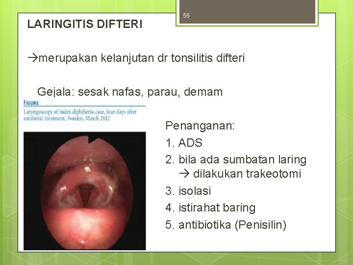 LARINGITIS DIFTERI 56 merupakan kelanjutan dr tonsilitis difteri Gejala: sesak nafas, parau, demam Penanganan: LARINGITIS DIFTERI 56 merupakan kelanjutan dr tonsilitis difteri Gejala: sesak nafas, parau, demam Penanganan: