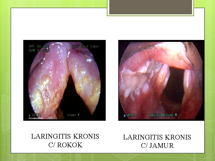 LARINGITIS KRONIS C/ ROKOK LARINGITIS KRONIS C/ JAMUR LARINGITIS KRONIS C/ ROKOK LARINGITIS KRONIS C/ JAMUR