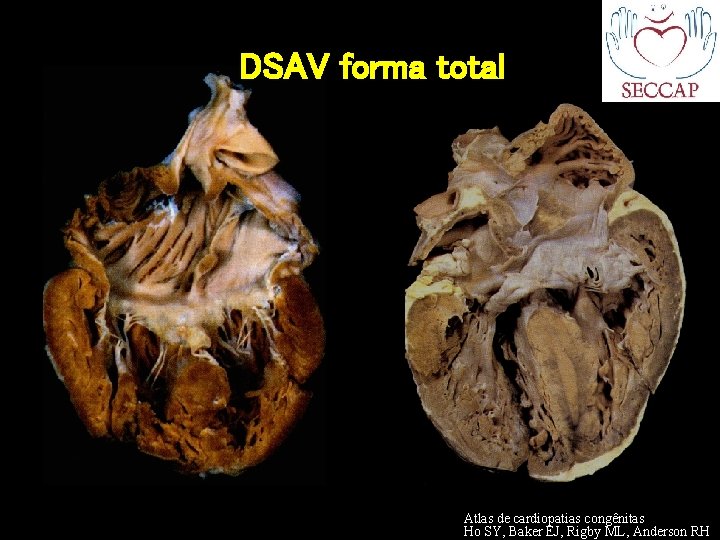 DSAV forma total Atlas de cardiopatias congênitas Ho SY, Baker EJ, Rigby ML, Anderson