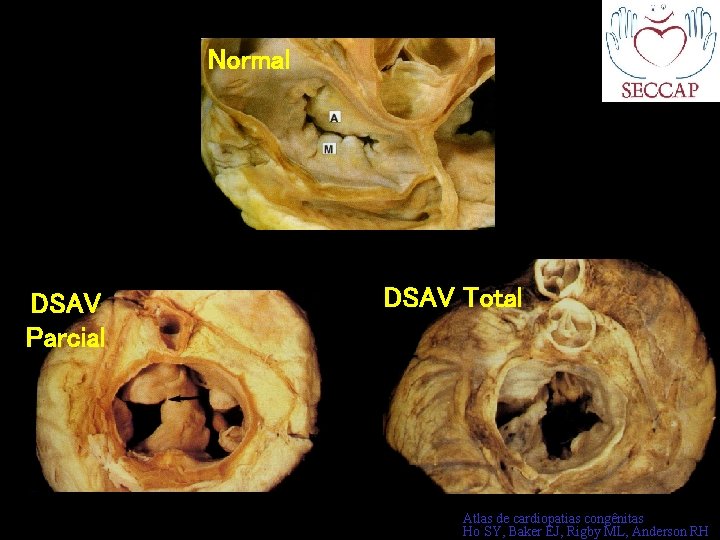 Normal DSAV Parcial DSAV Total Atlas de cardiopatias congênitas Ho SY, Baker EJ, Rigby