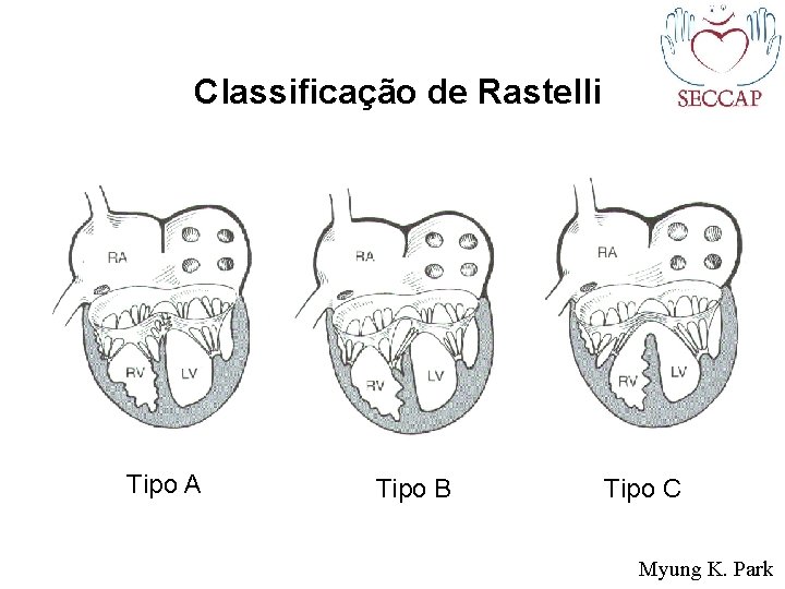 Classificação de Rastelli Tipo A Tipo B Tipo C Myung K. Park 
