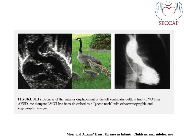 Moss and Adams' Heart Disease in Infants, Children, and Adolescents 