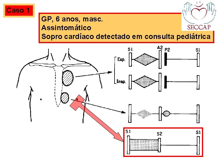 Caso 1 GP, 6 anos, masc. Assintomático Sopro cardíaco detectado em consulta pediátrica 