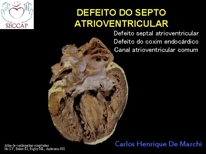 DEFEITO DO SEPTO ATRIOVENTRICULAR Defeito septal atrioventricular Defeito do coxim endocárdico Canal atrioventricular comum