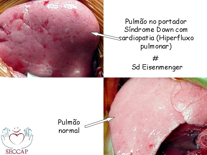 Pulmão no portador Síndrome Down com cardiopatia (Hiperfluxo pulmonar) # Sd Eisenmenger Pulmão normal