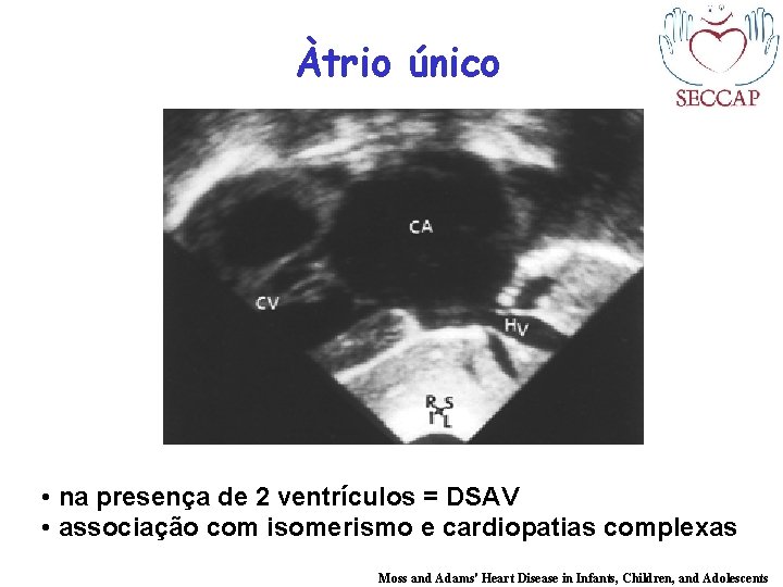 Àtrio único • na presença de 2 ventrículos = DSAV • associação com isomerismo