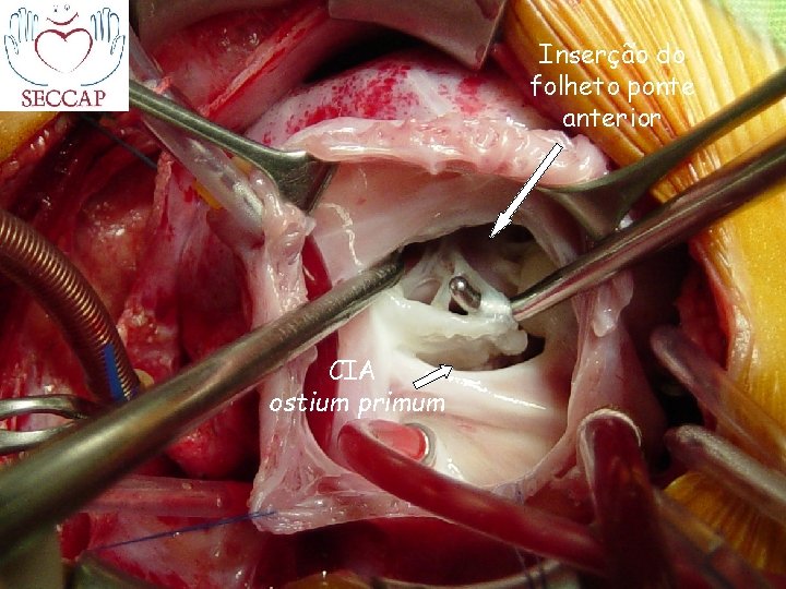 Inserção do folheto ponte anterior CIA ostium primum 