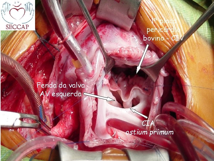 1ª placa pericárdio bovino - CIV Fenda da valva AV esquerda CIA ostium primum