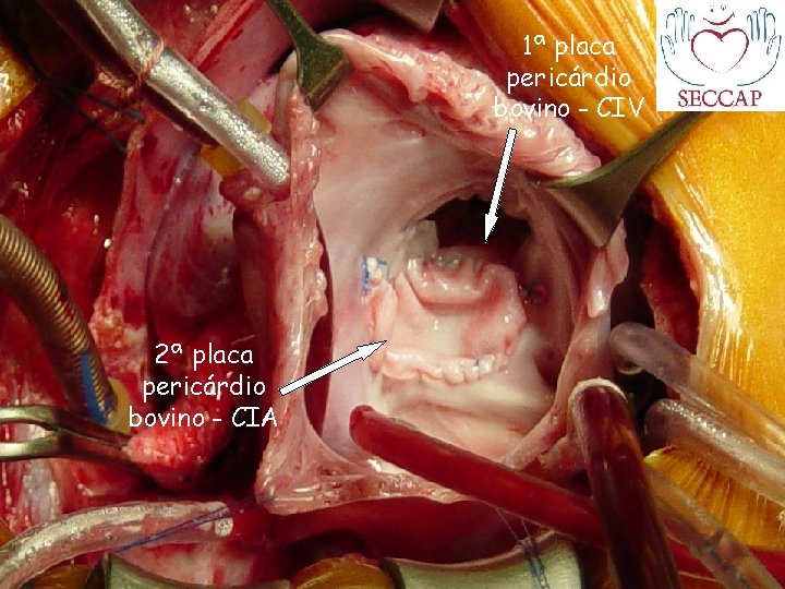 1ª placa pericárdio bovino - CIV 2ª placa pericárdio bovino - CIA 