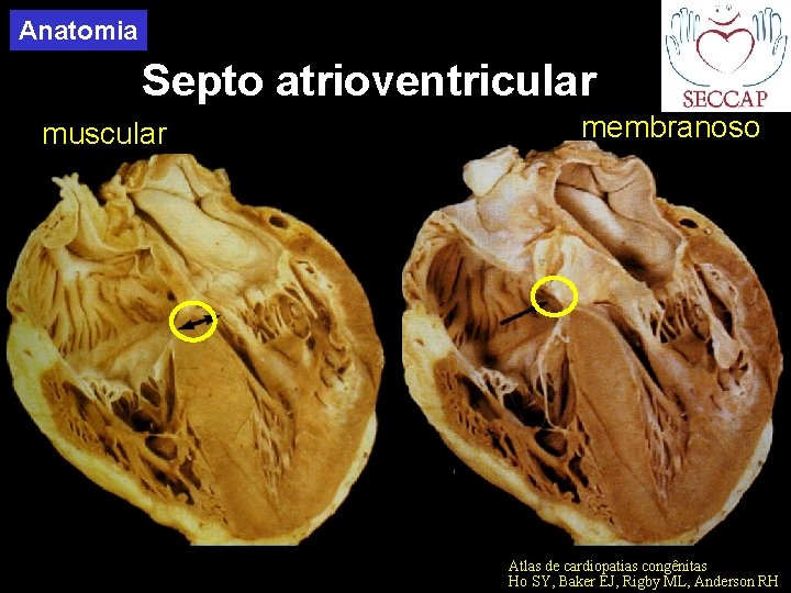 Anatomia Septo atrioventricular muscular membranoso Atlas de cardiopatias congênitas Ho SY, Baker EJ, Rigby