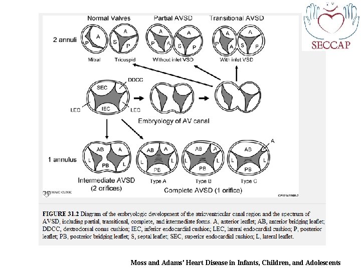 Moss and Adams' Heart Disease in Infants, Children, and Adolescents 