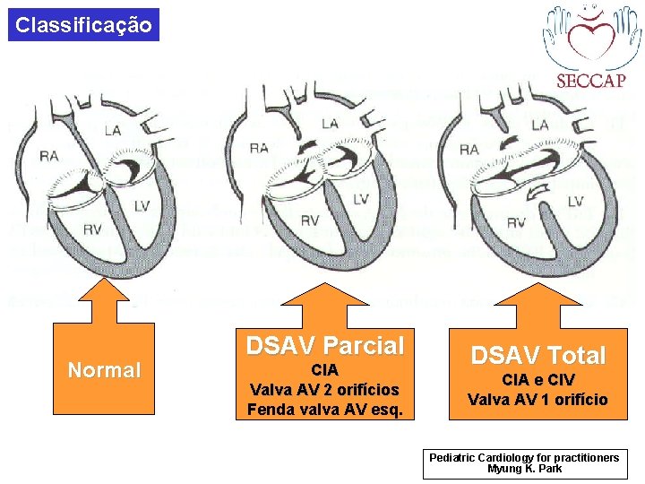 Classificação Normal DSAV Parcial CIA Valva AV 2 orifícios Fenda valva AV esq. DSAV