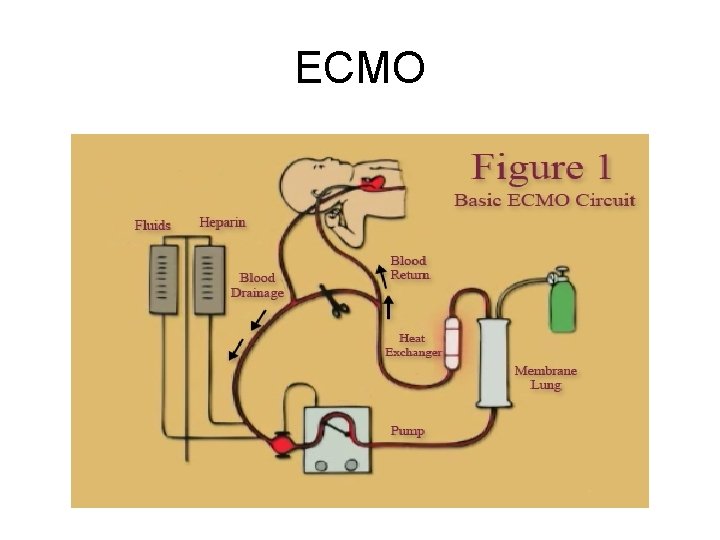 ECMO 