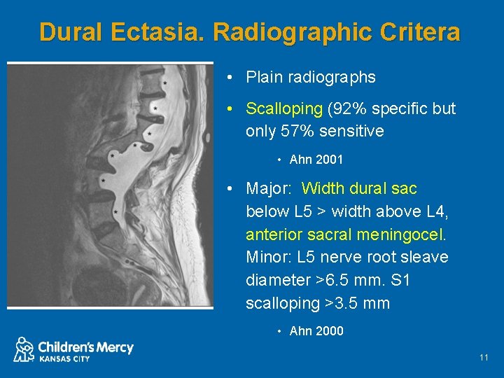 Dural Ectasia. Radiographic Critera • Plain radiographs • Scalloping (92% specific but only 57%