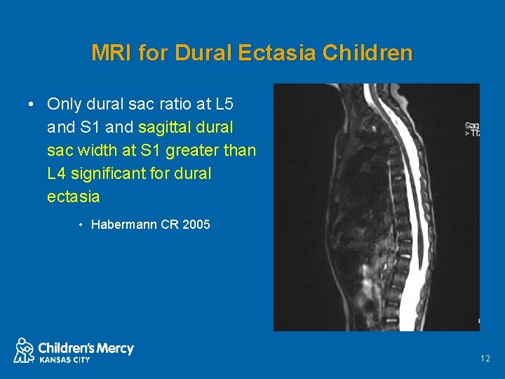 MRI for Dural Ectasia Children • Only dural sac ratio at L 5 and