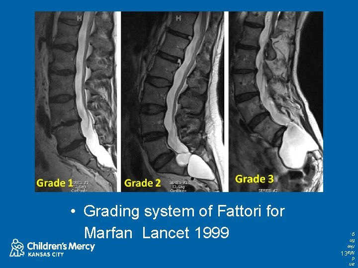 13 an d Ma rke tin g. • Grading system of Fattori for Marfan