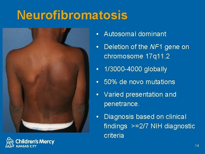 Neurofibromatosis • Autosomal dominant • Deletion of the NF 1 gene on chromosome 17