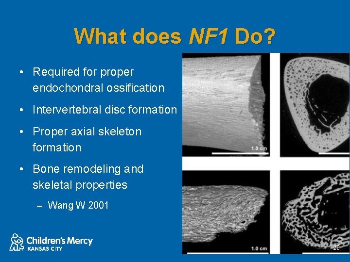 What does NF 1 Do? • Required for proper endochondral ossification • Intervertebral disc