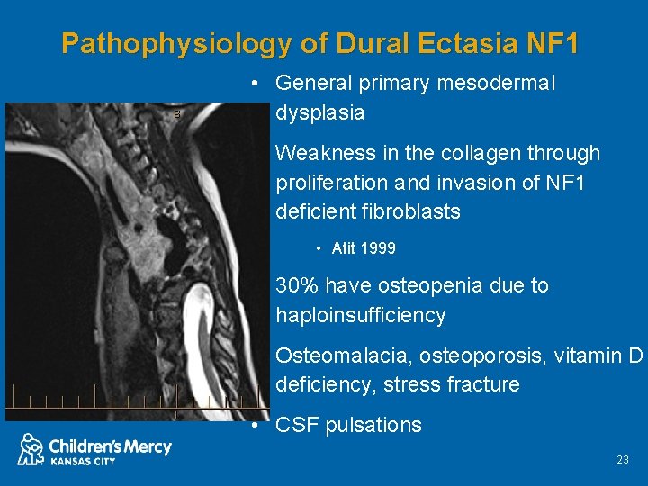 Pathophysiology of Dural Ectasia NF 1 • General primary mesodermal dysplasia • Weakness in
