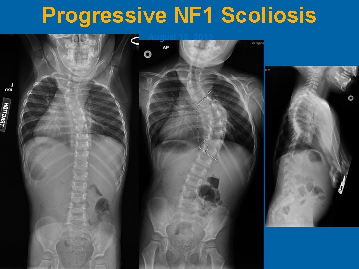 Progressive NF 1 Scoliosis August 12, 2013 