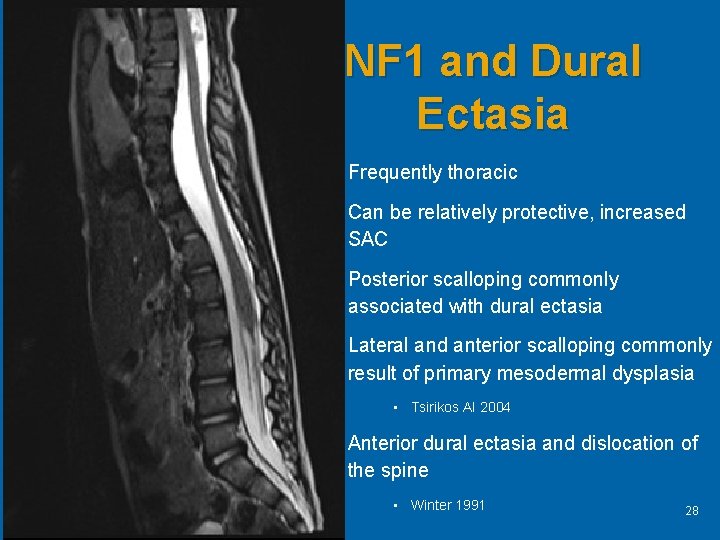 NF 1 and Dural Ectasia • Frequently thoracic • Can be relatively protective, increased