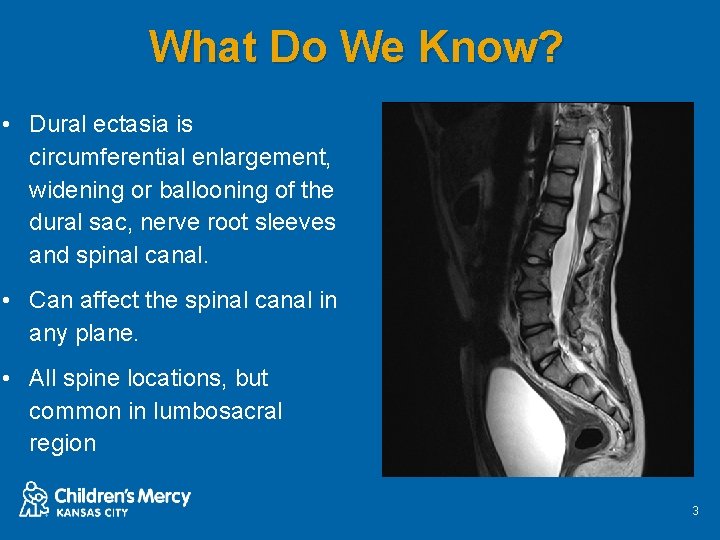 What Do We Know? • Dural ectasia is circumferential enlargement, widening or ballooning of